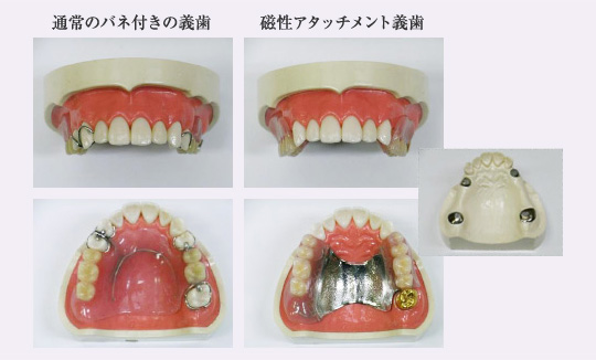 通常のバネ付きの義歯 磁性アタッチメント義歯