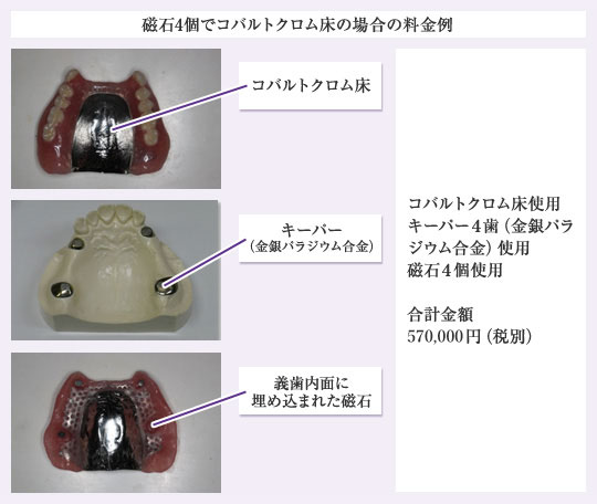 磁石4個でコバルトクロム床の場合の料金例 コバルトクロム床使用 キーパー4歯(金銀パラジウム合金)使用 磁石4個使用 合計金額570,000 円(税別)