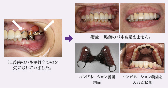 旧義歯のバネが目立つのを気にされていました。術後 奥歯のバネも見えません。コンビネーション義歯内面 コンビネーション義歯を入れた状態