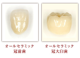 オールセラミック冠の治療例 オールセラミック冠前歯 オールセラミック冠大臼歯