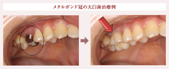 メタルボンド冠の大臼歯治療例