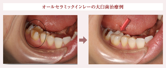 オールセラミックインレーの大臼歯治療例