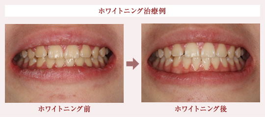 ホワイトニング治療例