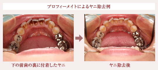 プロフィーメイトによるヤニ除去例