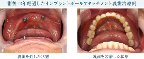 術後12年経過したインプラントボールアタッチメント義歯治療例 義歯を外した状態 義歯を装着した状態