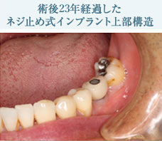 術後23年経過したネジ止め式インプラント上部構造