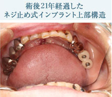 術後21年経過したネジ止め式インプラント上部構造
