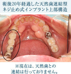 術後20年経過した天然歯連結型ネジ止め式インプラント上部構造