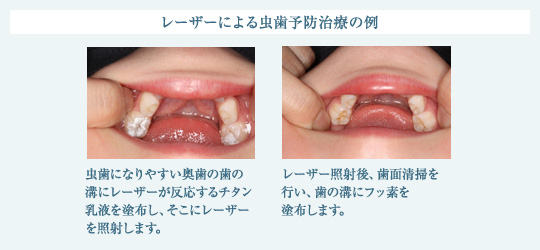 レーザーによる虫歯予防治療の例