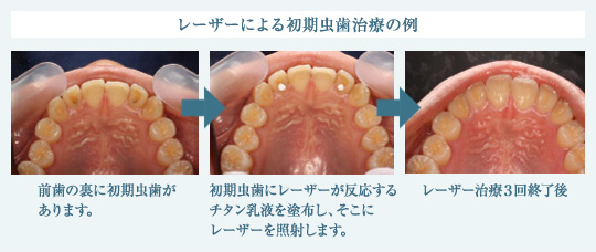 レーザーによる初期虫歯治療の例