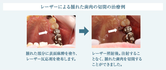 レーザーによる腫れた歯肉の切開の治療例