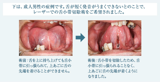 下は、成人男性の症例です。舌が短く発音がうまくできないとのことで、レーザーでの舌小帯切除術をご希望されました。
